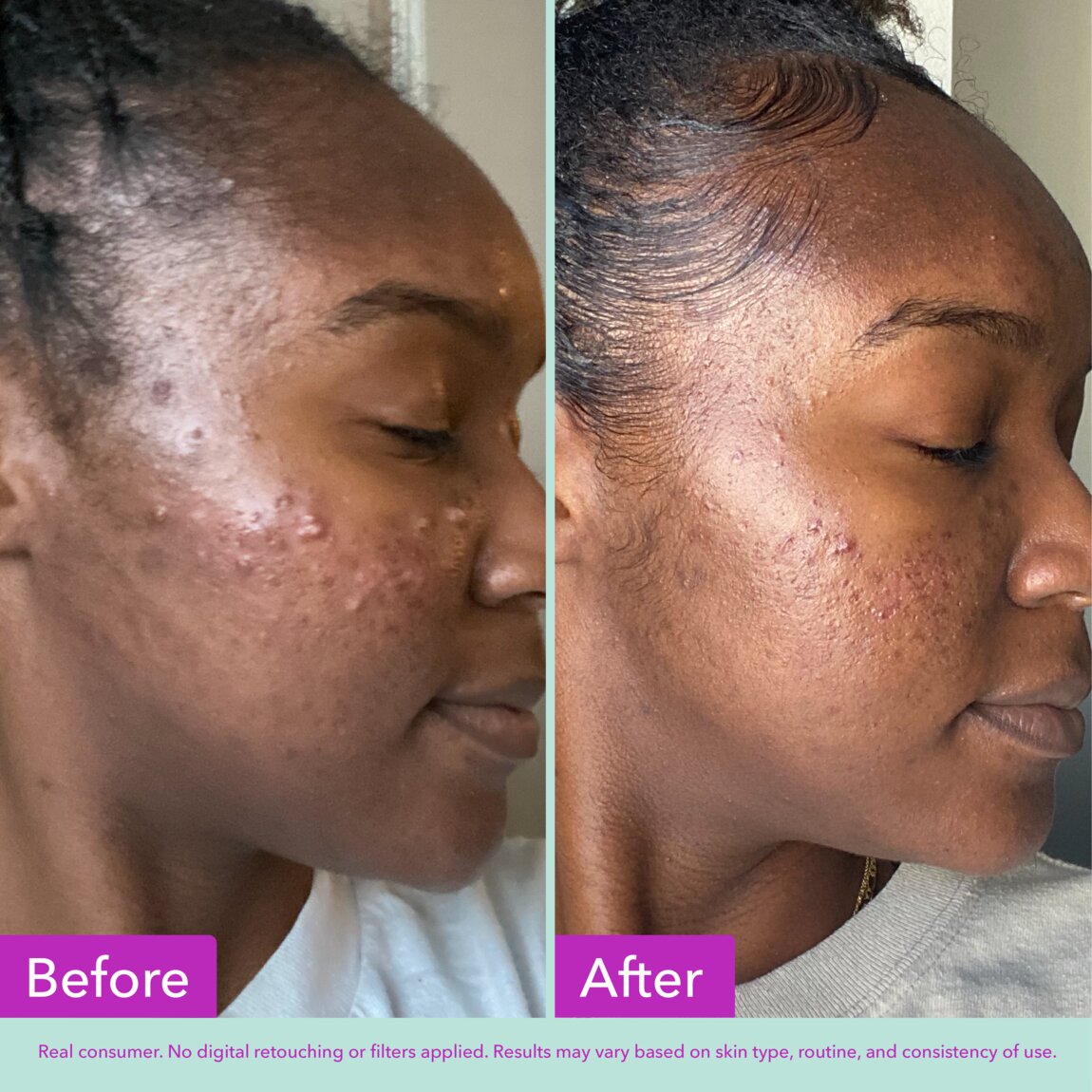 acne-foaming-cleanser-i7 zb_p.jpg
